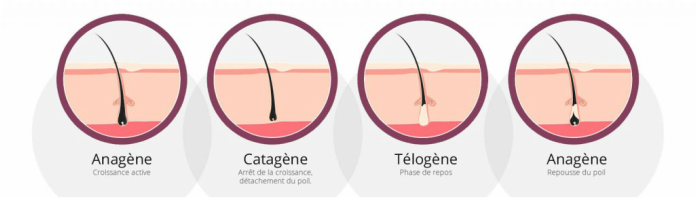 photodépilation lumière pulsée