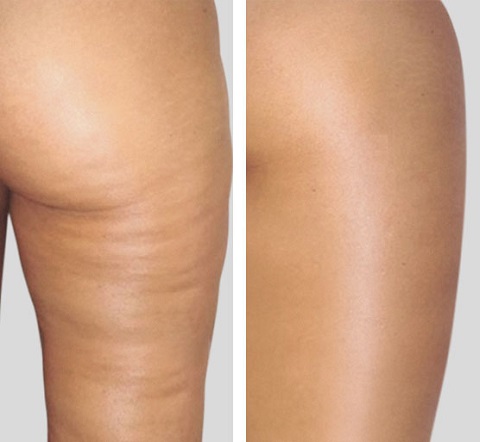 Avant/après 15 séances cellulite peau d'orange