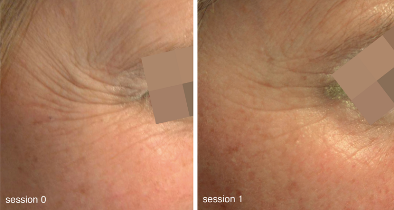 vanity-soin-mesoeclat peeling anti âge