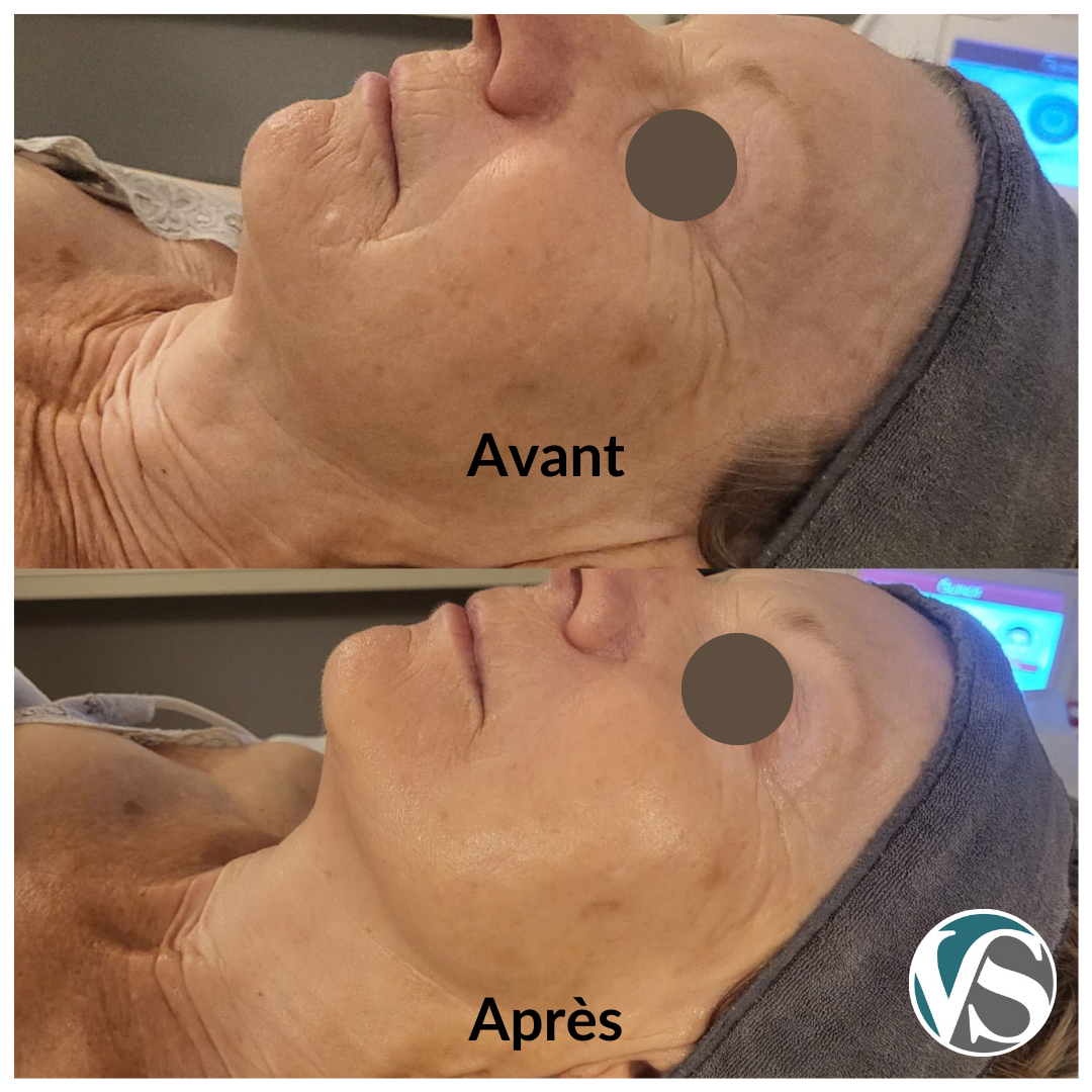 Hydradermie Lift Yvelines avant après