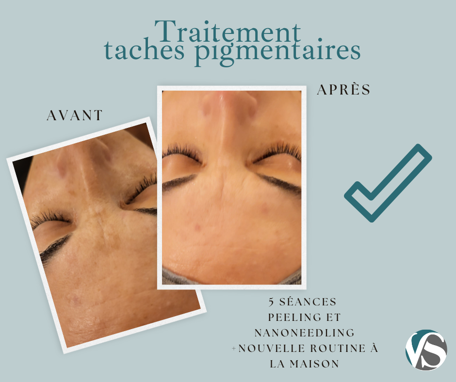 peeling taches pigmentaires