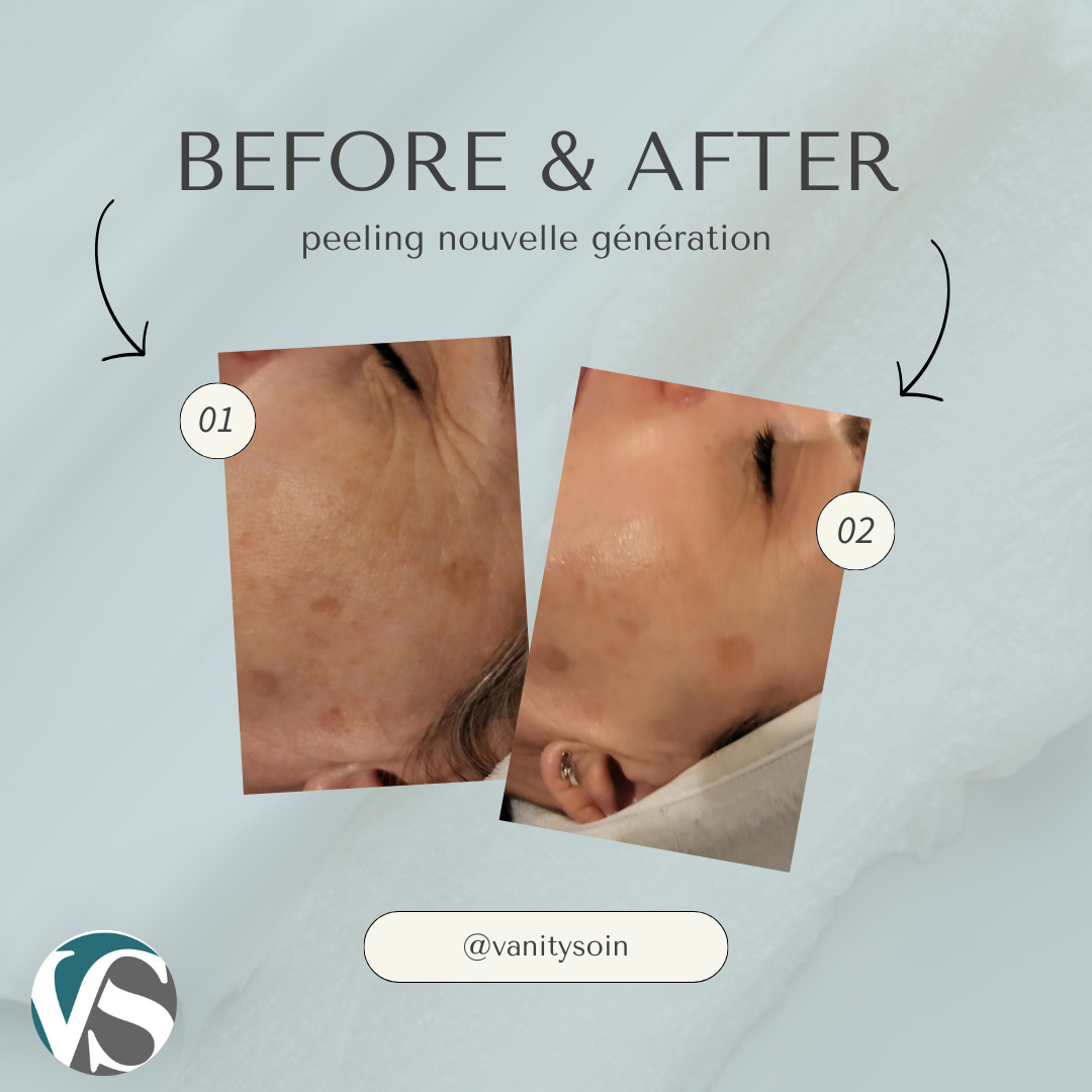 cliente 1 peeling taches pigmentaires