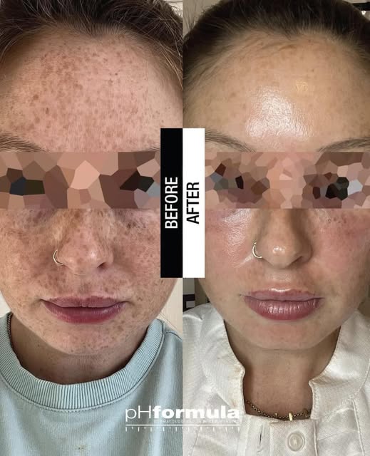 phformula-vanitysoin-peeling-tachepigmentaire peelin-vanitysoin-tache pigmentaires