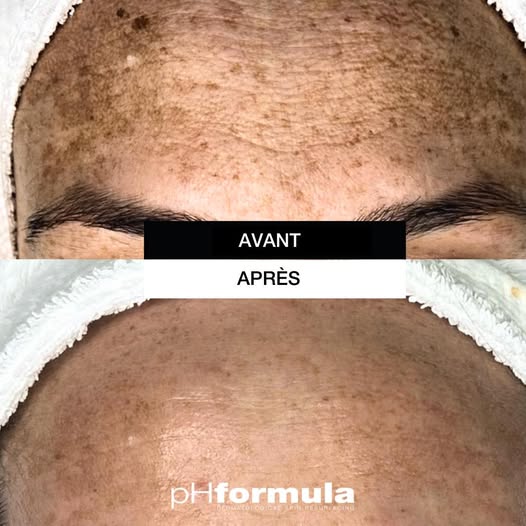 vanitysoin-phformula-tachepigmentaire peeling-taches pigmentaires
