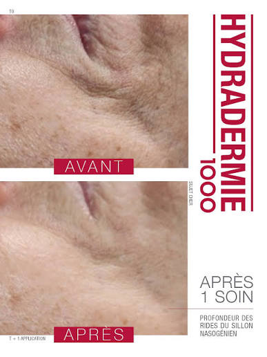 hydradermie lif yvelines